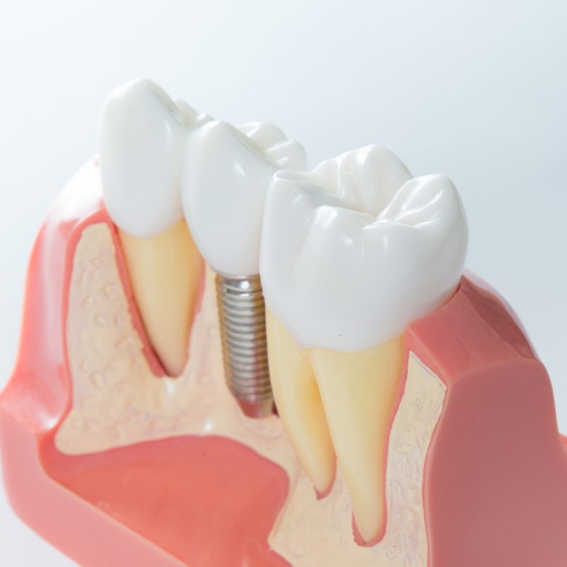 dental implant model